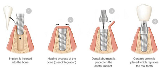Diagram of four phases of dental implants, including insertion, healing, abutment placement, and securing the crown.