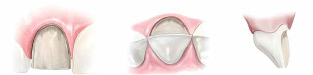 Three side-by-side diagrams of aggressive tooth preparation for porcelain veneers. 1) a single incisor with dentin exposed; 2) comparison of prepared tooth to its original state; 3) a side view of the tooth.