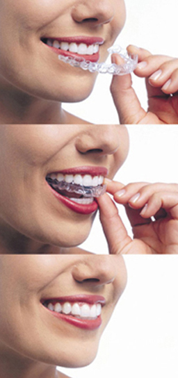 Three vertical photos of Invisalign: 1) A lady is holding the aligners up to her mouth; 2) She is placing them on her teeth; 3) She is wearing the aligners, and you can't see them.