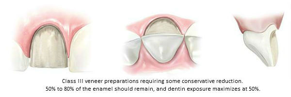 Diagram of Class III porcelain veneer preparations with conservative reduction. This classification was established by Beverly Hills accredited cosmetic dentist Dr. Brian LeSage.