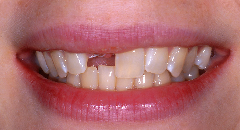 Dr. Brian LeSage Dentist Smile Gallery - Teeth before work