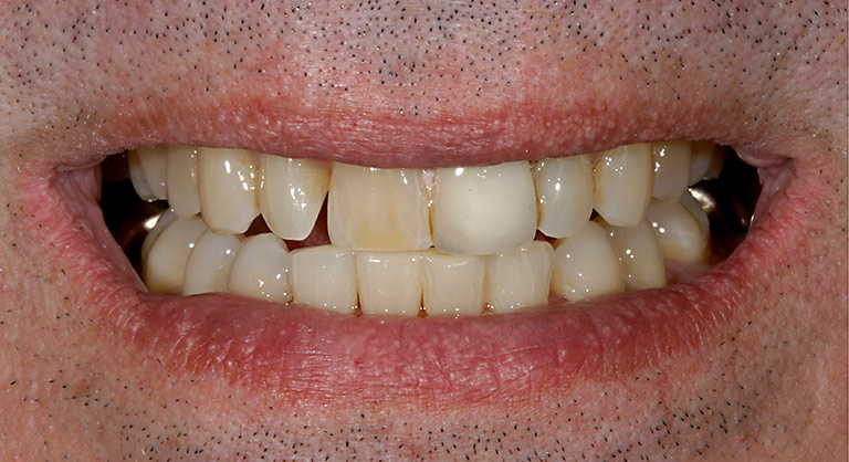 Dr. Brian LeSage Dentist Smile Gallery - Teeth before work