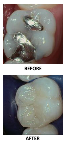 Before-and-after mercury-free dentist filling