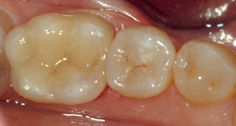 Dr. Brian LeSage Dentist Smile Gallery - Teeth after work