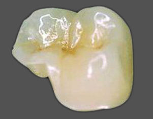 Porcelain onlay for a molar tooth, available in Beverly Hills from Dr. Brian LeSage.
