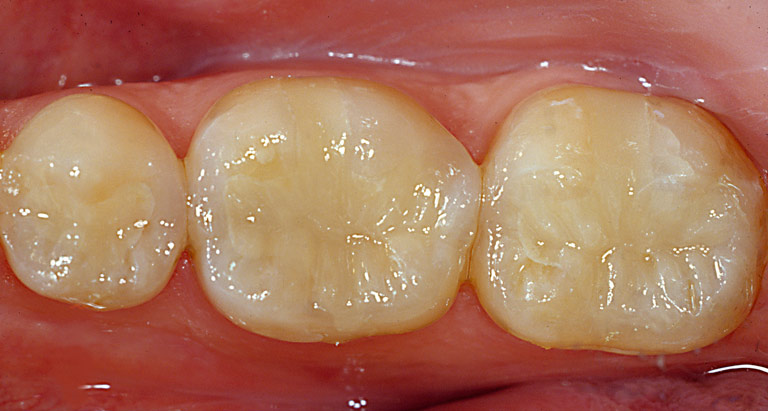 Dr. Brian LeSage Dentist Smile Gallery - Teeth after work