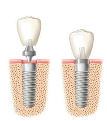 Diagram of a two dental implants - before and after crown placement
