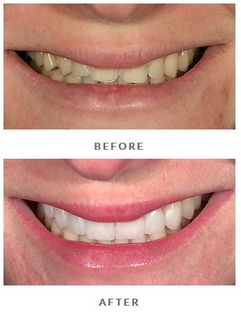 Before-and-after minimal prep porcelain veneers from Beverly Hills dentist Brian LeSage