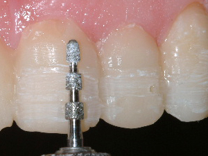 Depth-limiting diamond bur applied to teeth for porcelain veneer preparation