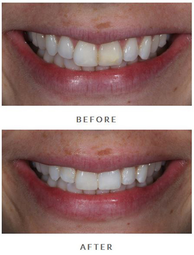 Before-and-after porcelain veneers photos from Beverly Hills cosmetic dentist Dr. LeSage