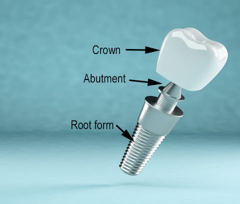 Dental implant crown, abutment, and root form