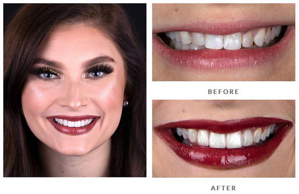 Patient case of making small adult teeth look larger from Beverly Hills accredited Fellow of cosmetic dentistry Dr. Brian LeSage.