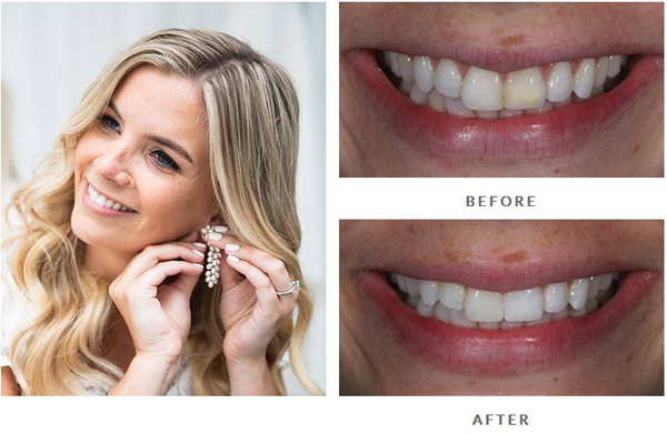 Dental bonding before and after photos of Beverly Hills Dr. LeSage's patient.