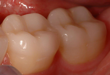 Porcelain onlays on molar teeth, portraying biomimetic dentistry from Beverly Hills cosmetic dentist Dr. LeSage