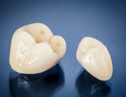 Dental crowns for molar teeth, available for replacement by Dr. LeSage of Beverly Hills