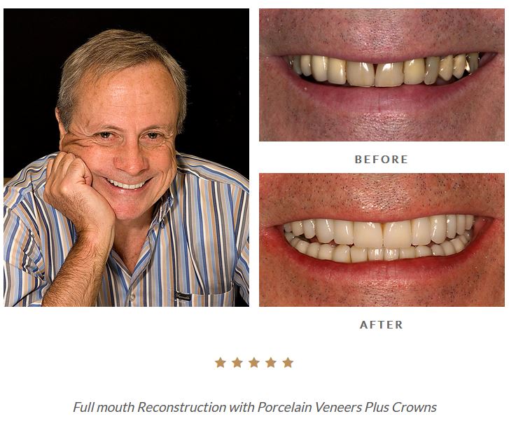 Before and after Beverly Hills smile makeover photos from the smile gallery of Dr. Brian LeSage.
