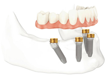 A diagram of a denture hovering above dental implants in the lower jawbone