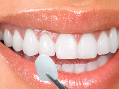 Dental forceps holding porcelain veneers next to a closeup smile
