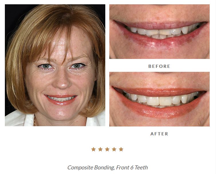 Full-face and close-up before and after pictures of dental bonding from Beverly Hills accredited cosmetic dentist Dr. Brian LeSage