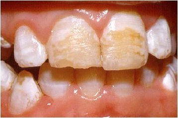 Severe enamel hypoplasia with deep brown horizontal grooves in the front teeth and many white spots on other teeth