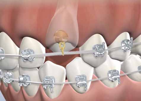 Canine tooth with a chain attached to braces wire to help guide it into position