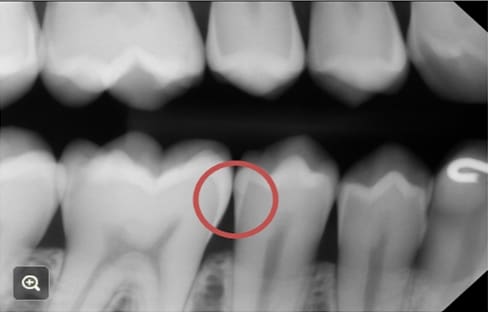 White spot lesions on a X-ray of teeth