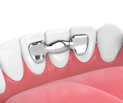 Maryland Bridge attached to back of three lower incisors